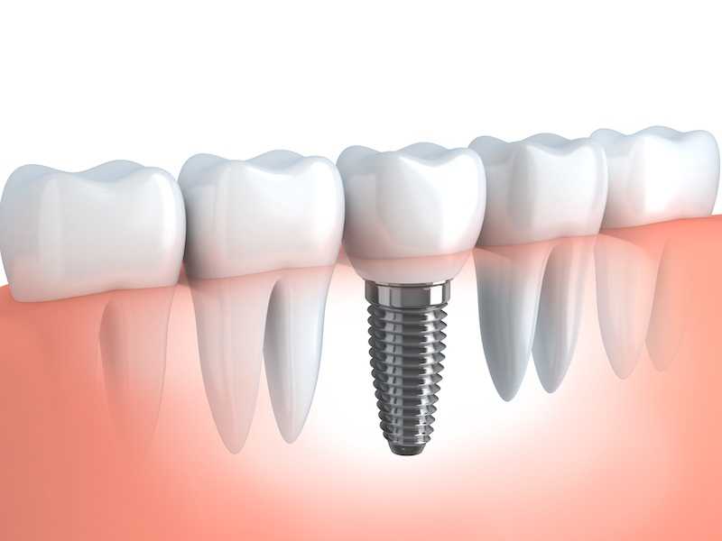 How Teeth Implants Can Provide You With A Vibrant Smile