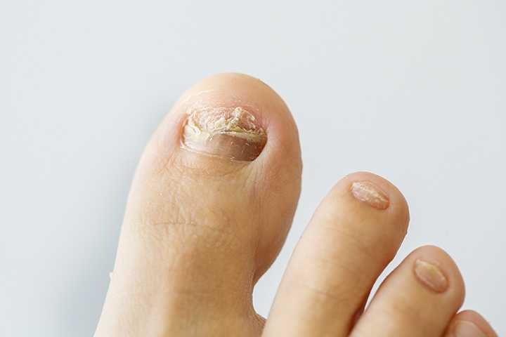 What Are the Causes of Ingrown Toenails?