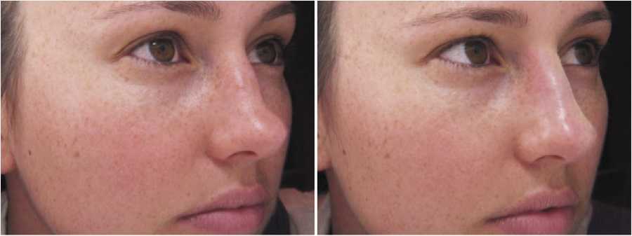 Attaining the most well shaped nose through filler and nose correction in Dubai
