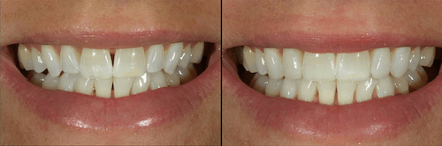 Composite Tooth Bonding
