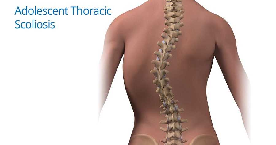 SCOLIOSIS: MEANING AND TREATMENT