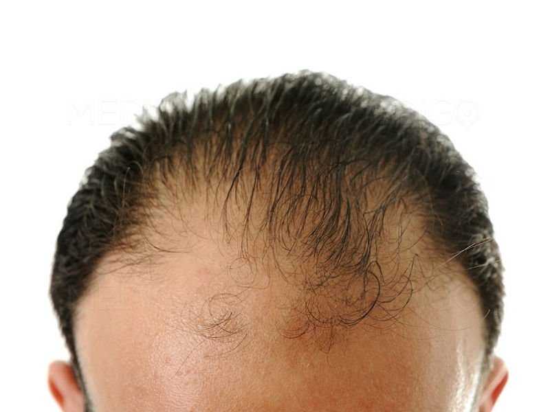 Criteria for Choosing Best Hair Transplant Surgeon in Jaipur