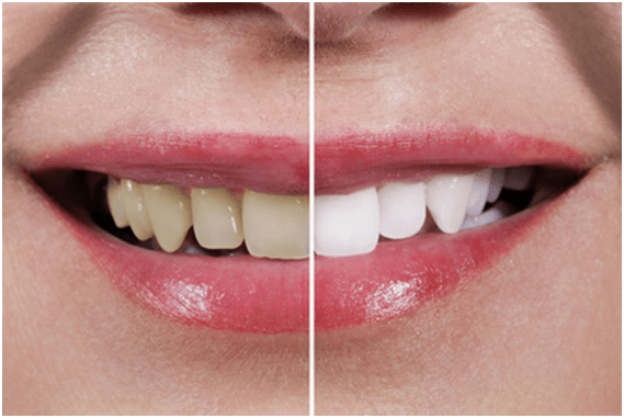 Teeth Whitening Myths