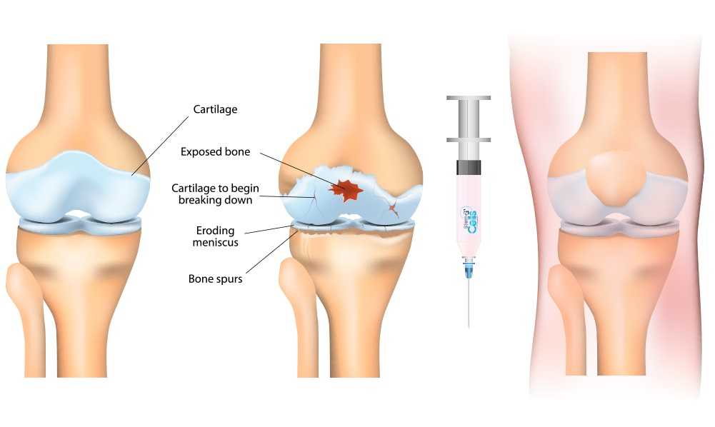 Stem Cell Treatment for Joints