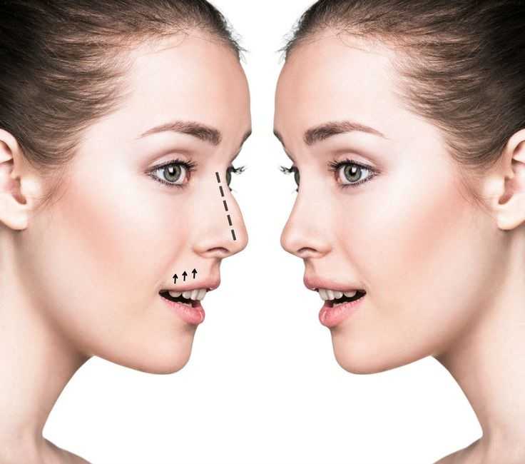 Overcoming Fear from Nose Job Surgery
