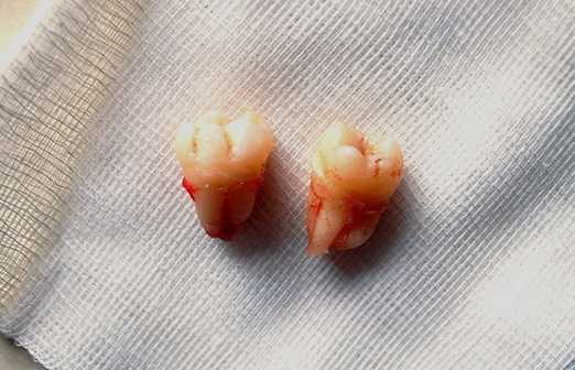What Are Your Options If You Have Missing Teeth?