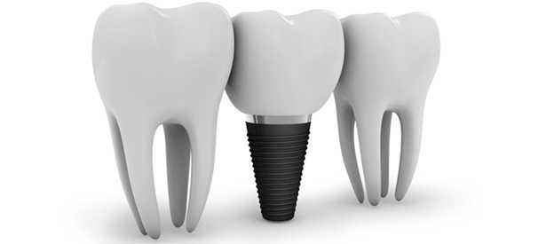 Cost of Dental Implants – What you need to know?