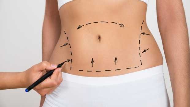 Liposuction; Uses and Benefits and Procedure