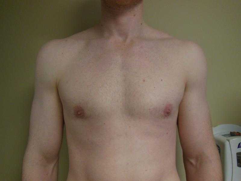 What is gynecomastia and how it can help men