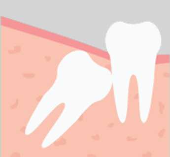 Cost of Extraction of Wisdom Teeth Removal and Tips to Reduce Them
