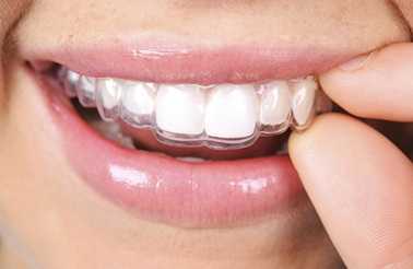 Invisible Brace Treatment – Aftercare Tips