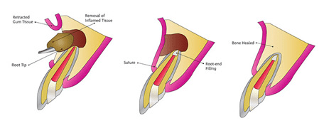Apicoectomy – A Step Further than a Root Canal Treatment
