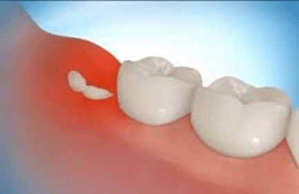 Cost Effective Solutions for Wisdom Teeth Removal in Sydney
