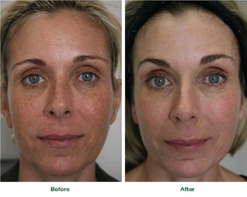Anti-aging Skin Treatments to Reduce Wrinkles and Look Younger