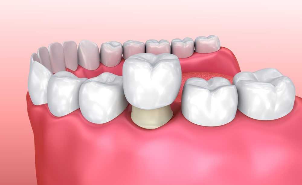 Get Familiar with Dental Crowns Mechanism and Installation