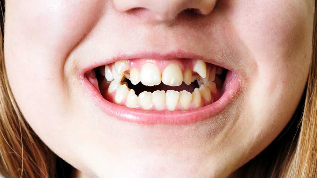 Have Crooked Teeth What To Expect When You Visit The Orthodontist