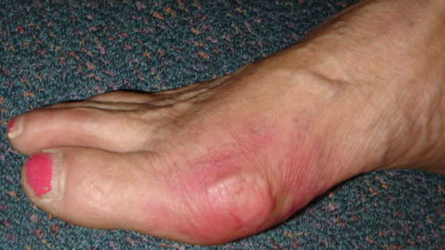 Gout Symptoms And Treatment, What You Should Know