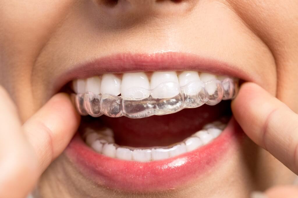 Benefits Offered by Invisalign