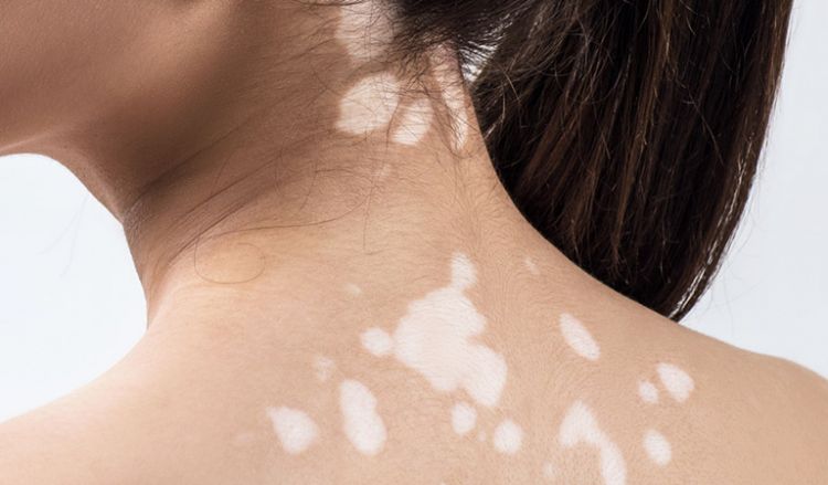 Vitiligo homeopathy treatments are always strategic