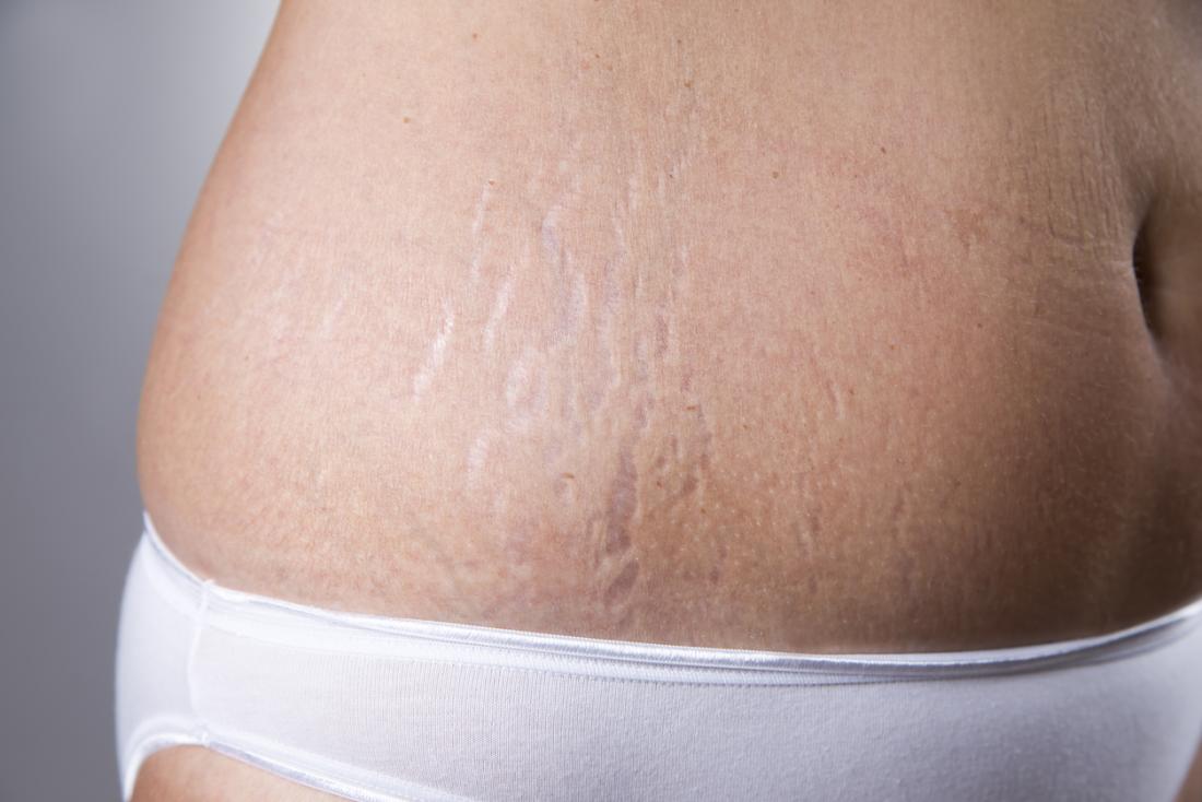 Is this the Right Topical Cream for Pain or Stretch-marks?