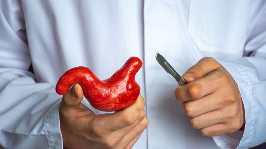 3 Common Myths of Bariatric Surgery