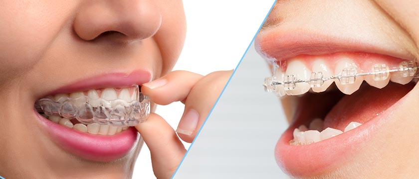 Which Option, Braces Vs. Invisalign: Is Better For You?