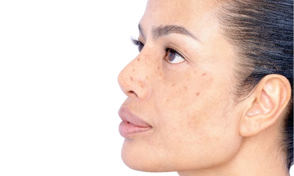 Pico Laser: The Quick Fix for Skin Rejuvenation in Singapore