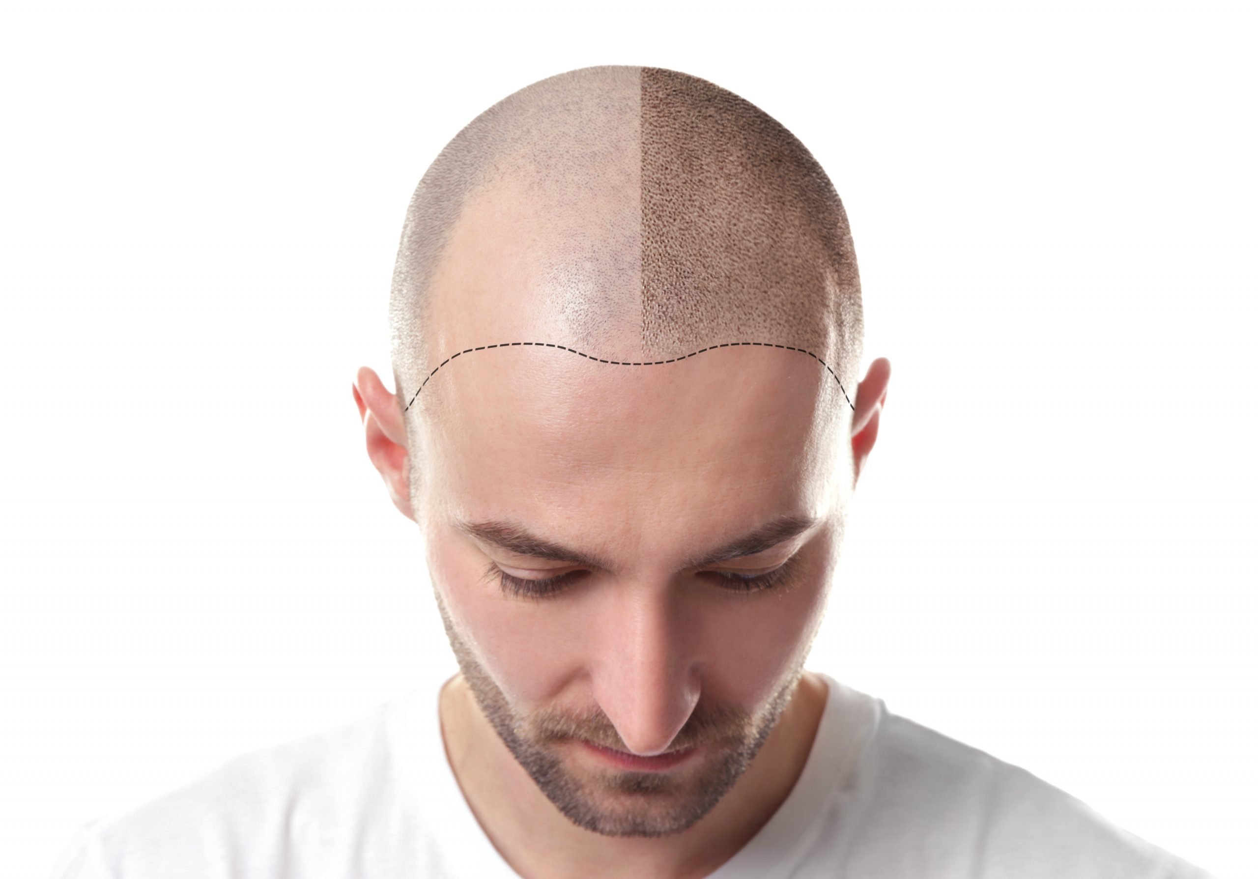 The Essential AfterCare for Scalp Micro Pigmentation