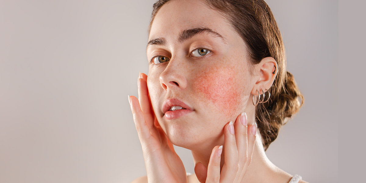 Rosacea Treatment in Singapore: A Comprehensive Guide to Non-Surgical Solutions