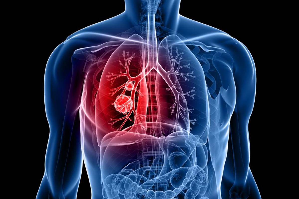 Lung Cancer Needle Biopsy: A Minimally Invasive Sampling Method