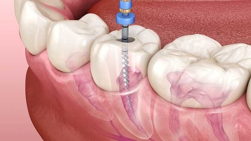 Understanding Root Canal Treatment: When Your Tooth Needs a Second Chance