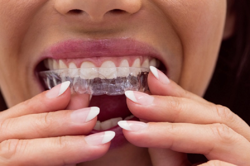 Transforming your teeth with Invisalign Hertfordshire
