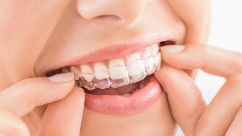 Embracing orthodontic transformation: the comprehensive benefits of invisible aligners