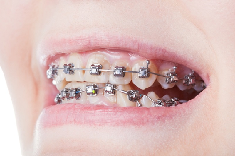 Getting Invisalign to enhance your smile