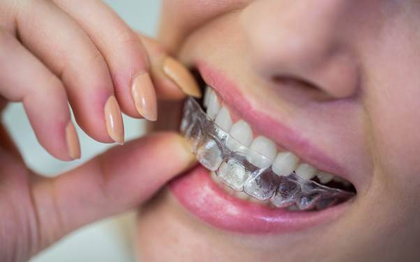 Invisalign vs Braces in Singapore: Which is the Better Option for You?