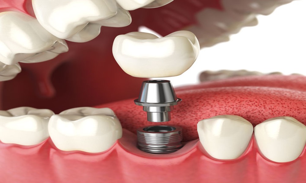 Benefits Of Single And Multiple Tooth Replacements