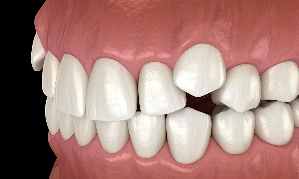 Why Oral Surgeons Are Often Needed For Impacted Canines